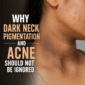 dark neck pigmentation